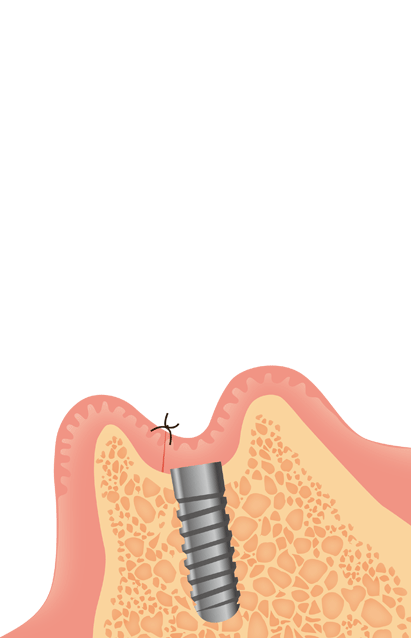 インプラント埋入手術のイラスト