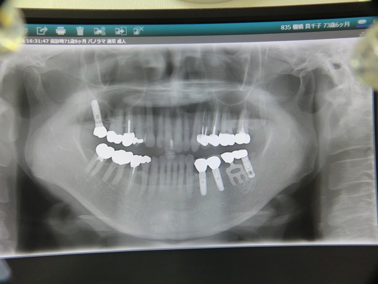 インプラント症例