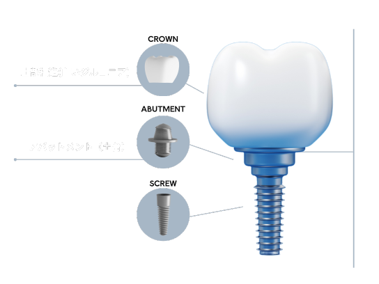 インプラントイメージ