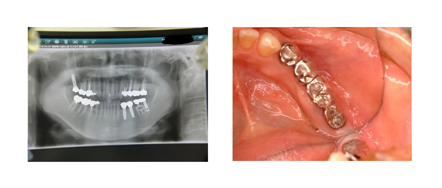 レントゲンと口腔内の写真