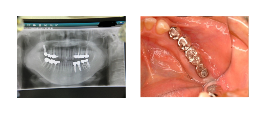 レントゲンと口腔内の写真